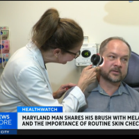 CBS Baltimore - How a routine skin check helped a Maryland man detect melanoma early